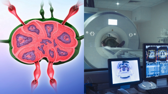 Predicting lymph node metastasis in tumors using CT-based radiomics ...